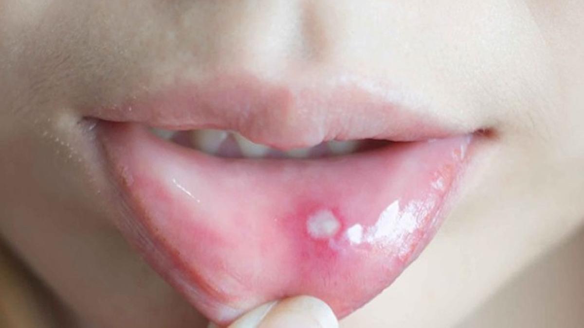 Prevención de las llagas en la boca