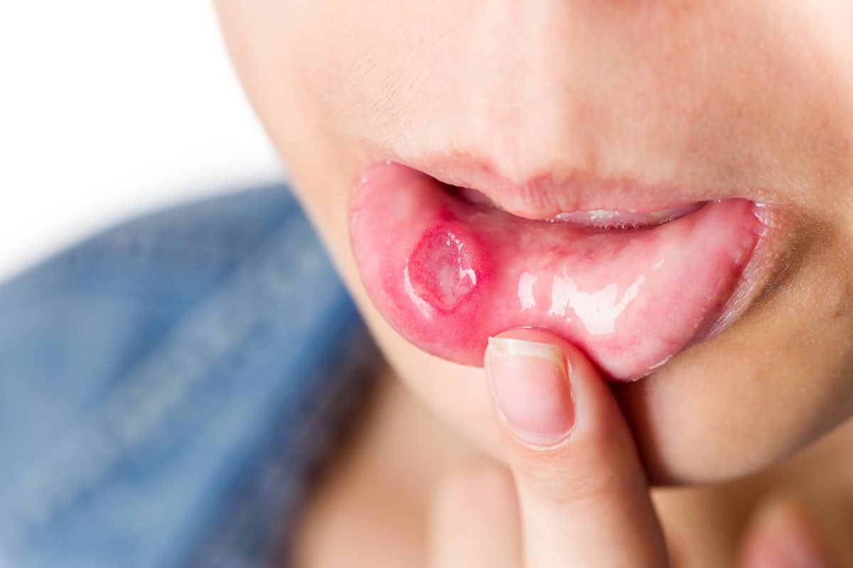 Cómo curar llagas en la boca